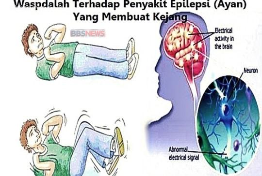 Tips Mengetahui Gejala Epilepsi atau Penyakit Ayan